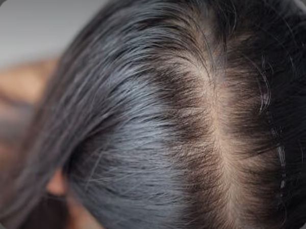 does creatine cause hair loss in women